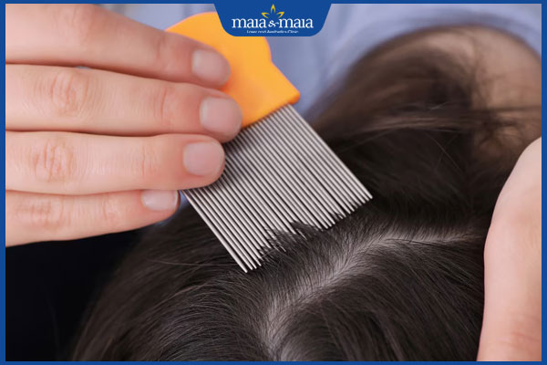 Cảm giác có côn trùng bò trên tóc là bị làm sao? Cách xử lý 3 chải chấy giận