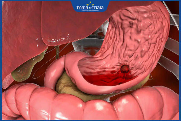 chảy máu dạ dày