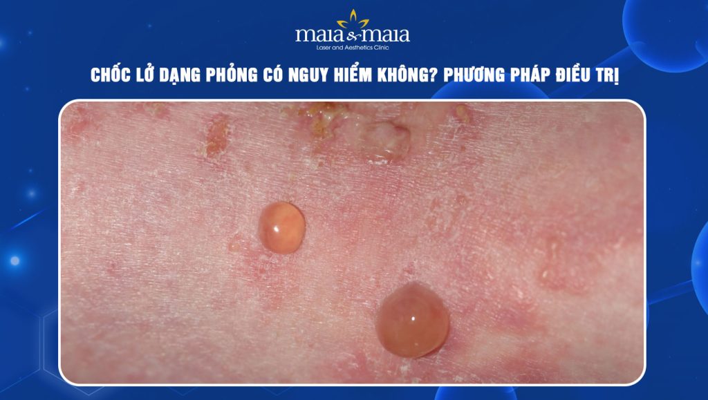 Chốc lở dạng phỏng có nguy hiểm không? Phương pháp điều trị 1 Chốc lở dạng phỏng