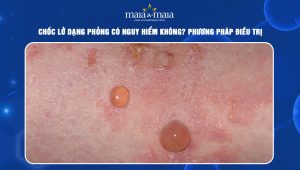 Chốc lở dạng phỏng