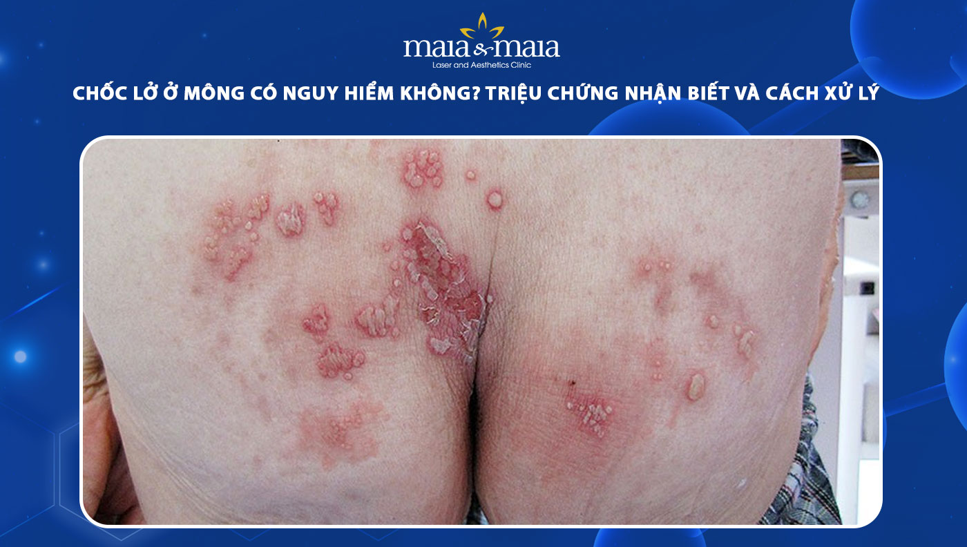 chốc lở ở mông