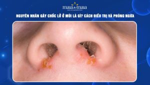 Chốc lở ở mũi