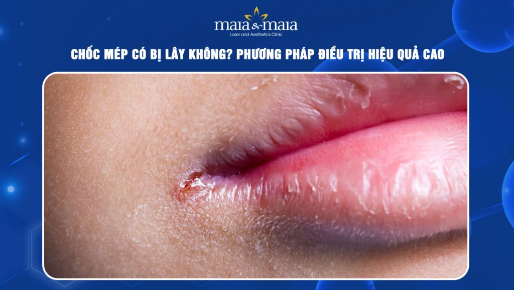 Dấu hiệu nhận biết chốc mép và phương pháp điều trị hiệu quả 1 Chốc mép