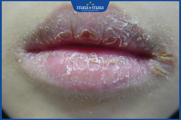 Dấu hiệu nhận biết chốc mép và phương pháp điều trị hiệu quả 4 chốc mép đóng vảy