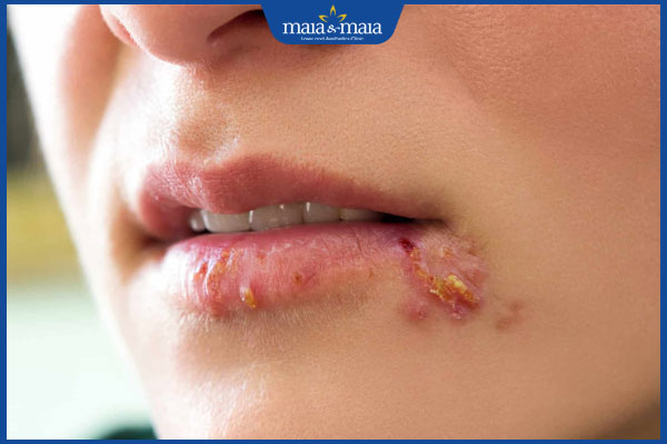 chốc mép lây lan