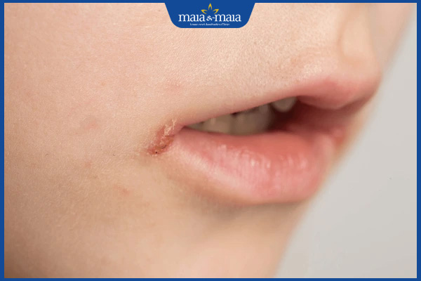 Dấu hiệu nhận biết chốc mép và phương pháp điều trị hiệu quả 2 chốc mép nhẹ