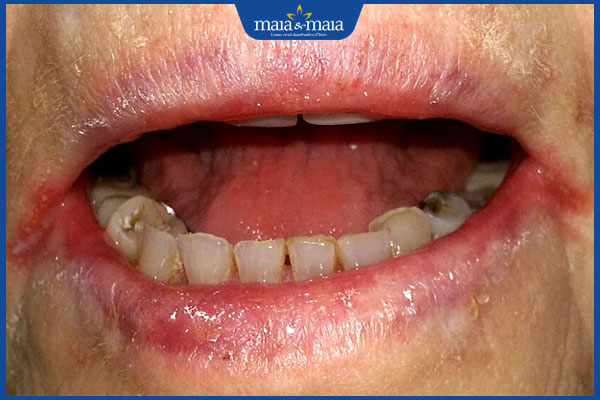 Dấu hiệu nhận biết chốc mép và phương pháp điều trị hiệu quả 5 chốc mép nứt môi