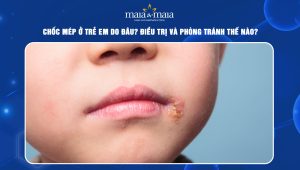 Chốc mép ở trẻ em