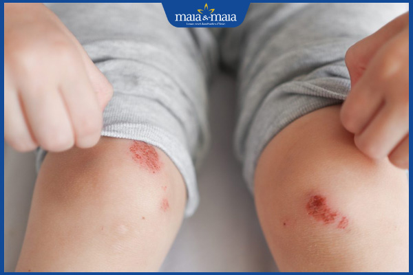 chốc ở chân trẻ