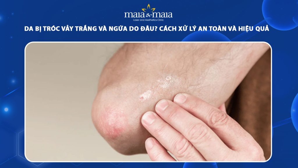 da bị tróc vảy trắng và ngứa