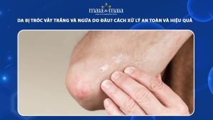 da bị tróc vảy trắng và ngứa