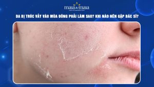 Da bị tróc vảy vào mùa đông