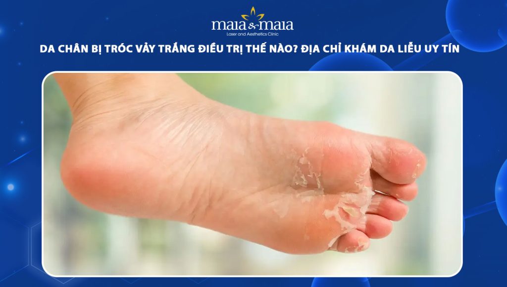 da chân bị tróc vảy trắng