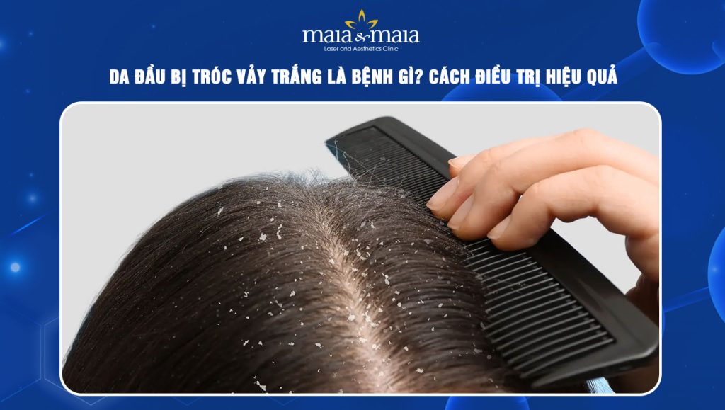 da đầu bị tróc vảy trắng