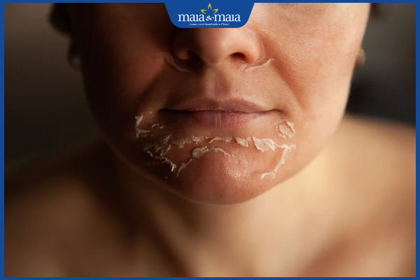 da mặt bị bong tróc