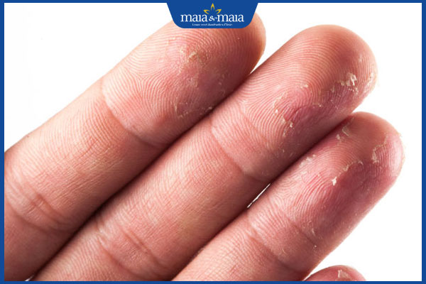 da tay bị bong tróc