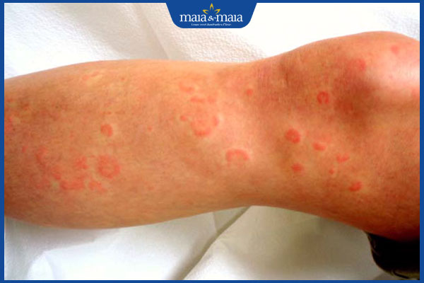 dấu hiệu nhận biết hồng ban đa dạng