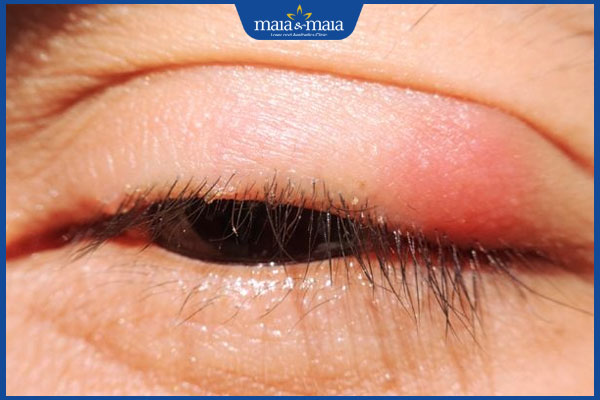 Viêm da do Demodex có chữa được không? Lưu ý ngừa tái phát 3 dấu hiệu viêm bờ mi