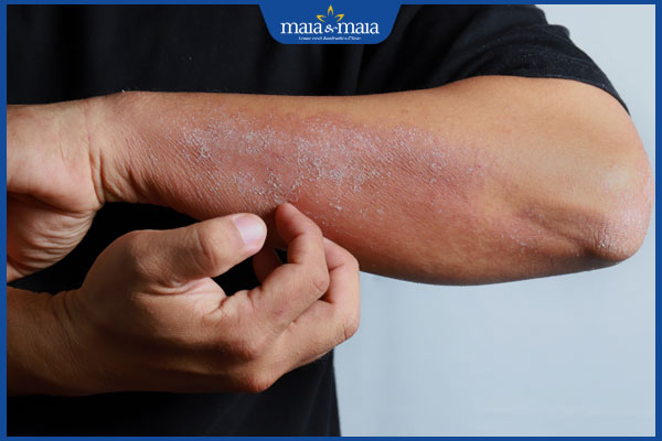 Viêm da atopy do đâu? Gợi ý cách điều trị hiệu quả 2 dấu hiệu viêm da atopy