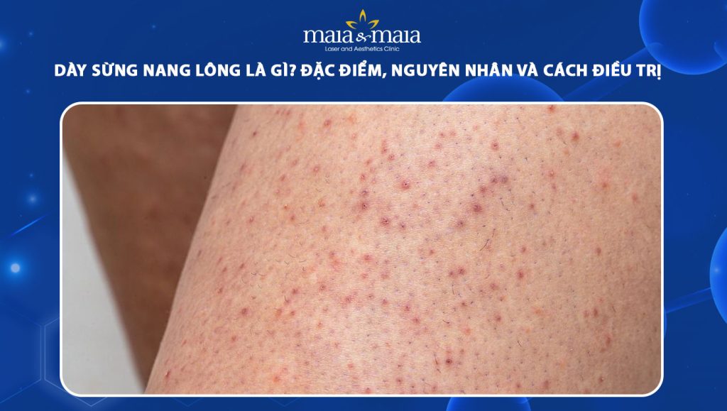 dày sừng nang lông