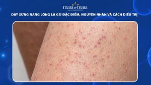 dày sừng nang lông