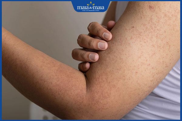 dày sừng nang lông gây tự ti