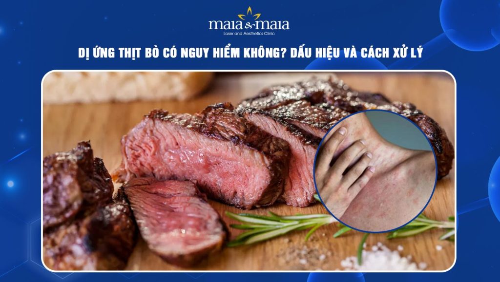 dị ứng thịt bò