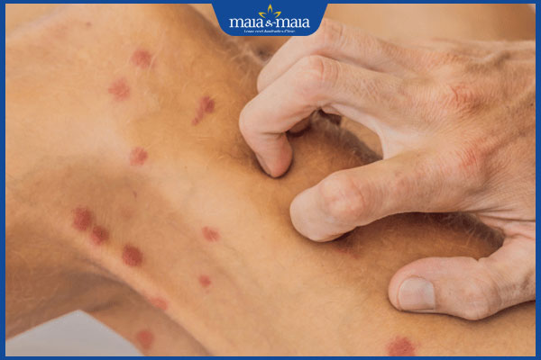 đốm đỏ nổi trên da và ngứa
