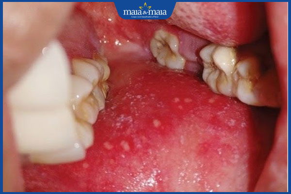 Sốt phát ban và sởi có gì khác nhau? Điều trị và phòng ngừa 6 đốm trắng Koplik đặc trưng trong miệng