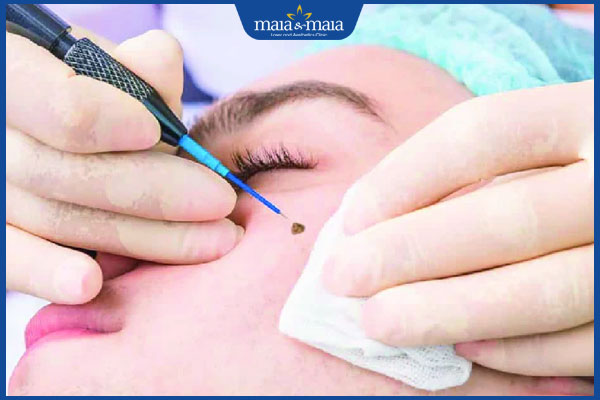 Điều trị sẩn cục bằng đốt điện có hiệu quả không? 4 đốt sẩn cục