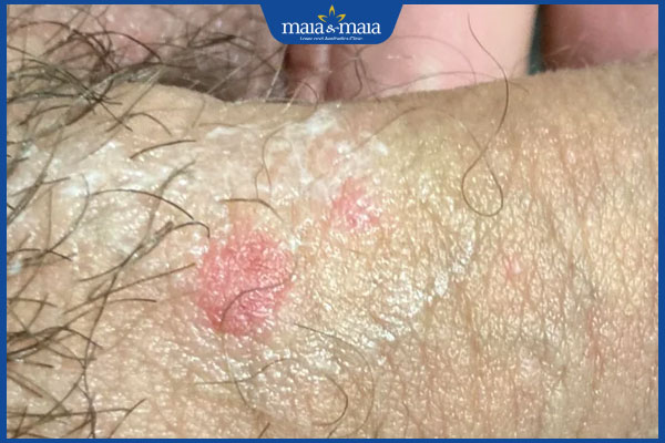 dương vật mẩn đỏ tróc da