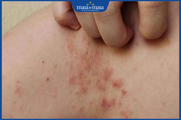 Bệnh chốc lở có lây không? Làm sao để hạn chế lây lan? 2 gãi chốc loét