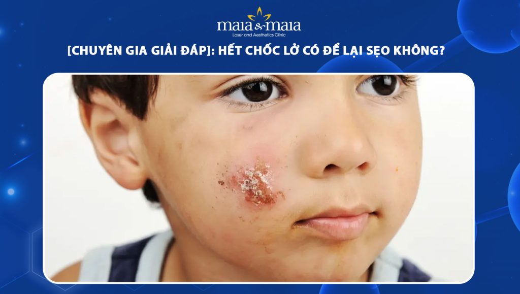 hết chốc lở có để lại sẹo không