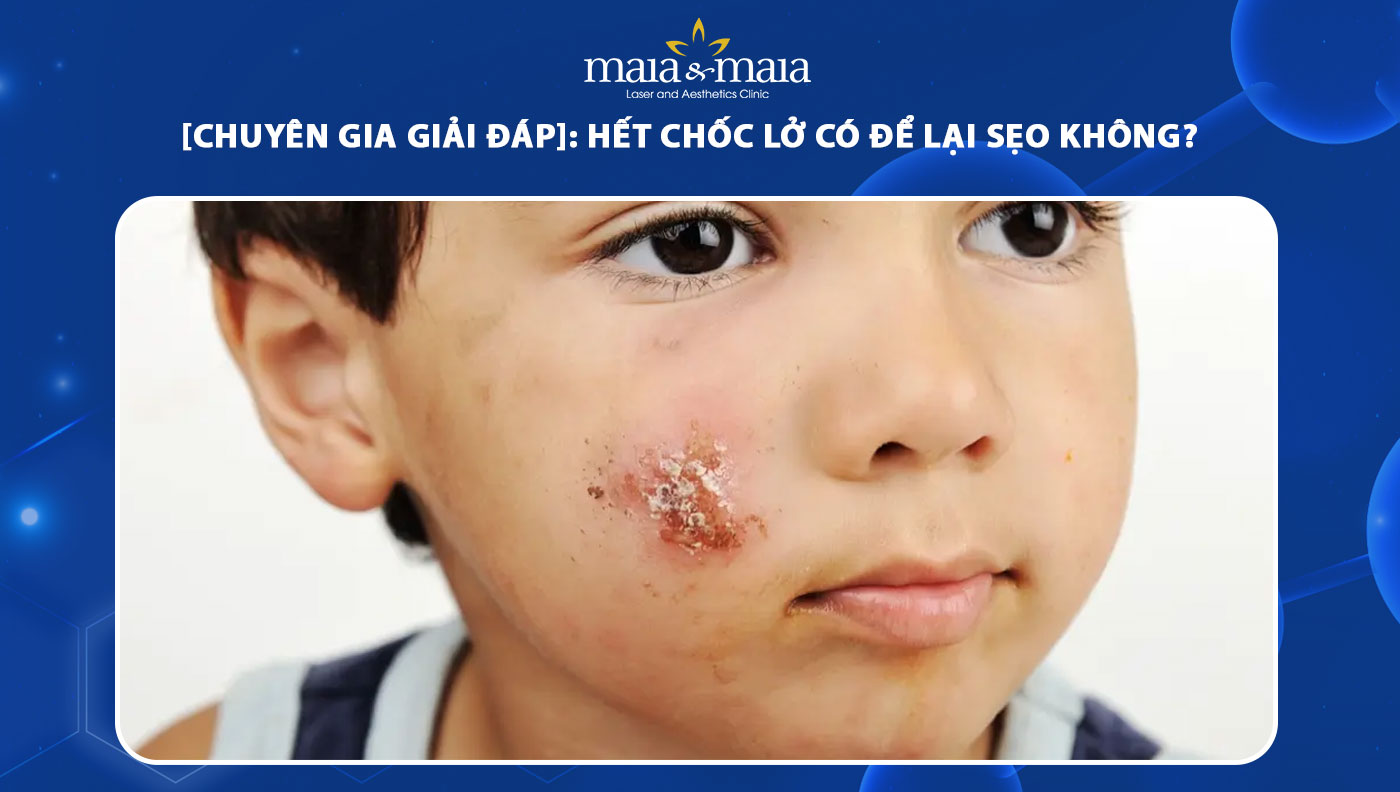 hết chốc lở có để lại sẹo không