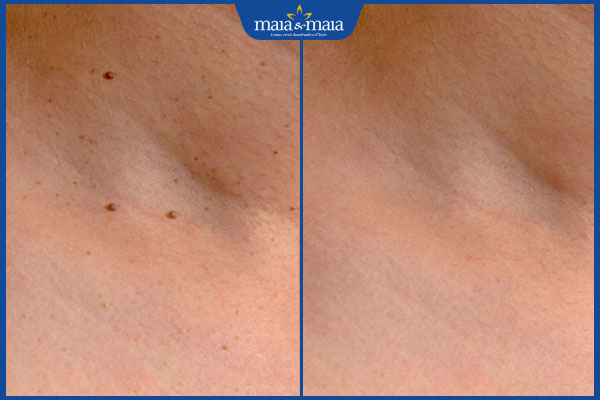 Điều trị sẩn cục bằng đốt điện có hiệu quả không? 2 hiệu quả trị sẩn cục