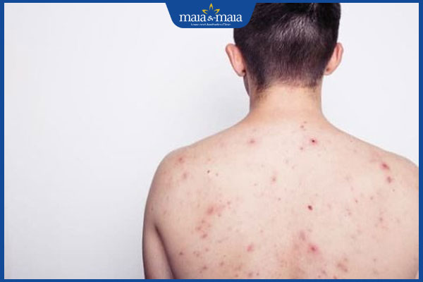 Dấu hiệu nhận biết phát ban HIV và cách xử lý khi gặp phải 3 hình ảnh phát ban hiv giai đoạn đầu