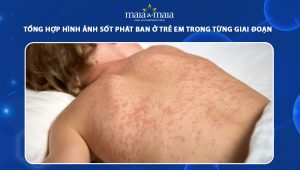 hình ảnh sốt phát ban ở trẻ em