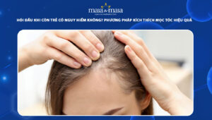 hói đầu khi còn trẻ