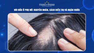 Hói đầu ở phụ nữ