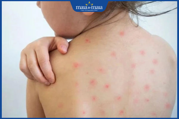 Sốt phát ban và sởi có gì khác nhau? Điều trị và phòng ngừa 10 hồi phục sau sởi