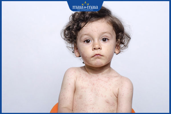 Sốt phát ban và sởi có gì khác nhau? Điều trị và phòng ngừa 9 hồi phục sau sốt phát ban