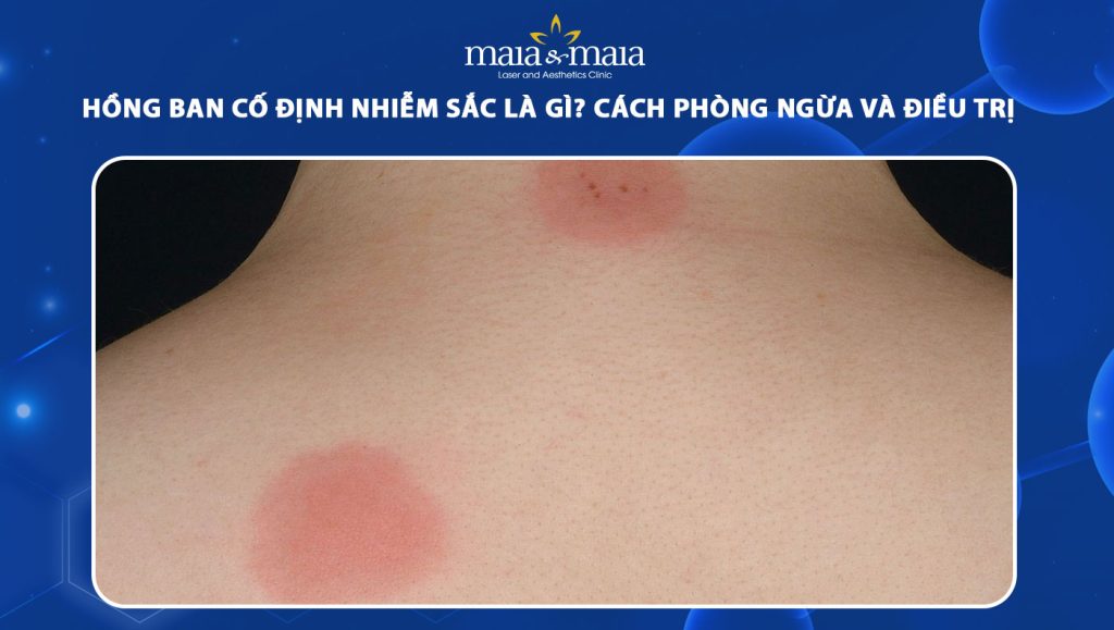 hồng ban cố định nhiễm sắc