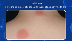 hồng ban cố định nhiễm sắc