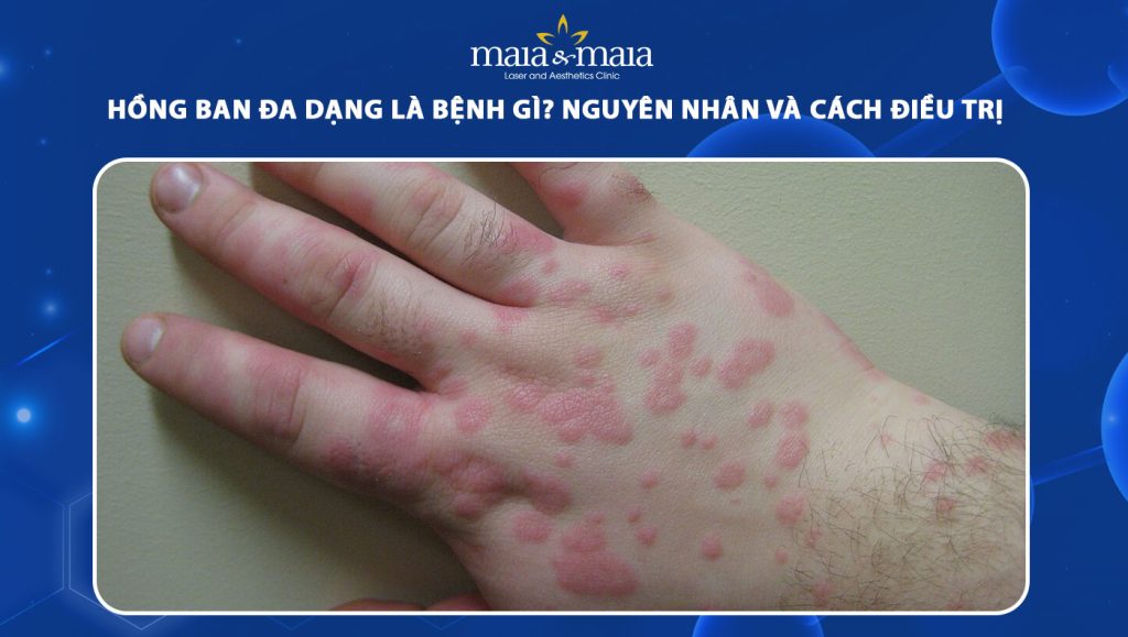 hồng ban đa dạng