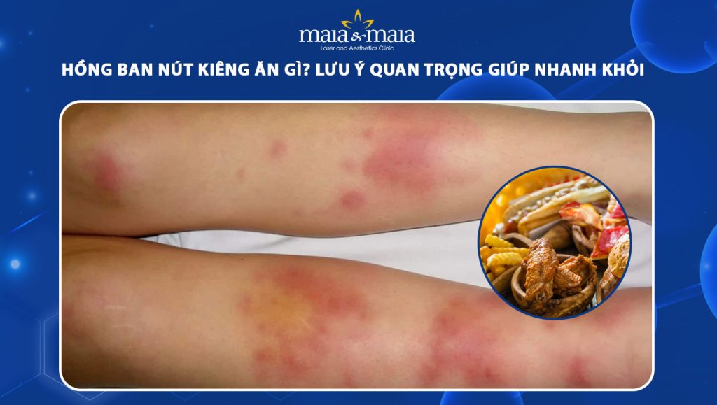 hồng ban nút kiêng ăn gì