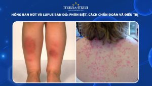 hồng ban nút và lupus ban đỏ