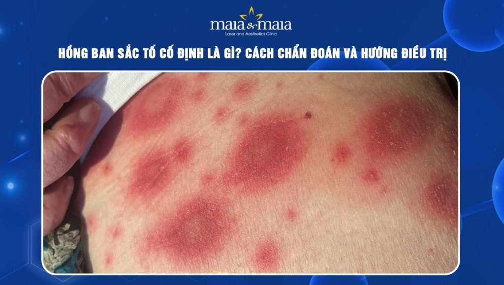 Hồng ban sắc tố cố định