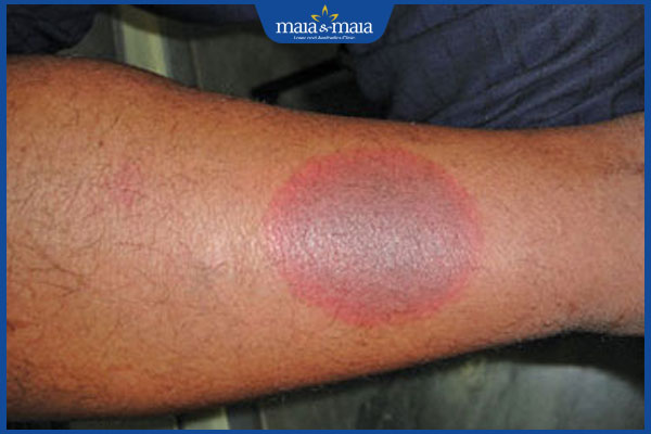 hồng ban sắc tố cố định ở chân