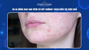 hồng ban sau viêm