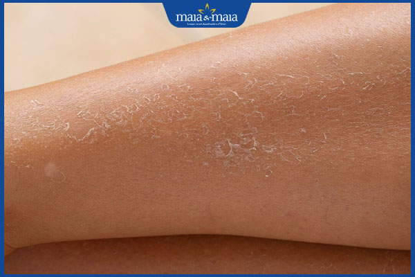 khô da vào mùa đông